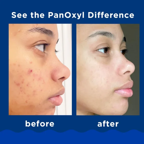 PanOxyl – Acne Foaming Wash (10% Benzoyl Peroxide) - Image 5